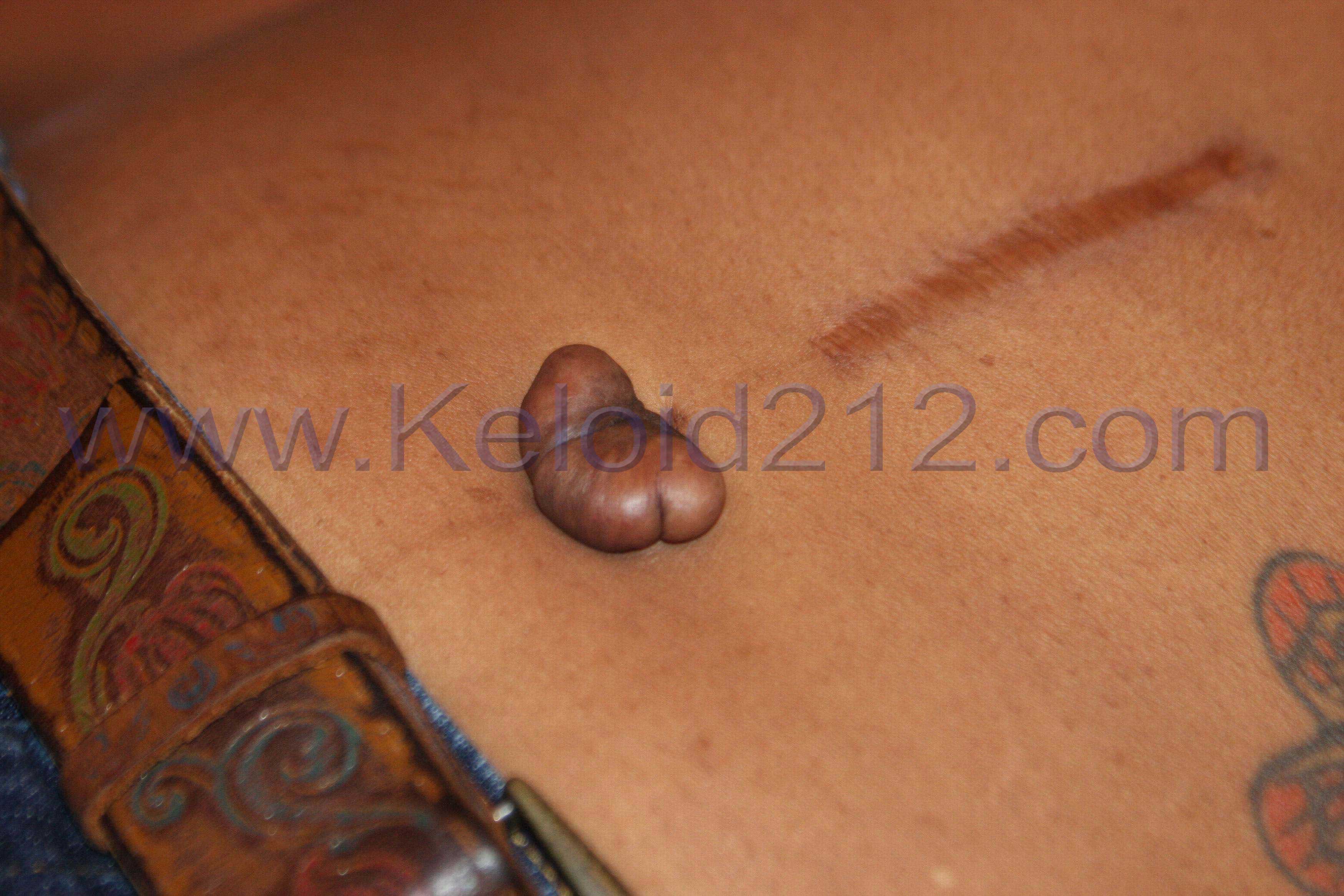 Location Specific Keloids Keloid Removal Expert New York